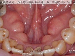 舌头能舔到口腔下颚有硬疙瘩图片口腔下颚硬疙瘩产品介绍