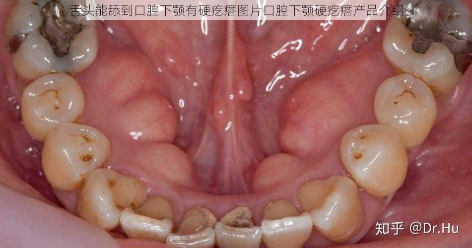 舌头能舔到口腔下颚有硬疙瘩图片口腔下颚硬疙瘩产品介绍